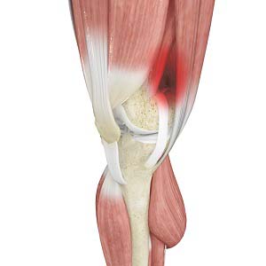 Iliotibial Band Syndrome Raleigh  Iliotibial Band Syndrome Surgery Cary,  Garner