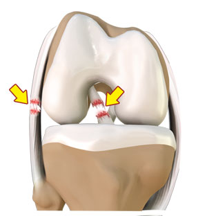 Ligament Injuries