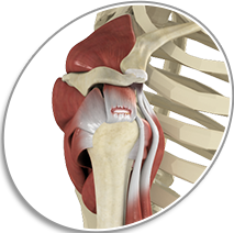 Rotator Cuff Repair